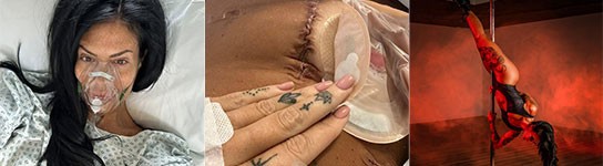 My stoma saved my life: Bryony Gray’s Stoma Story