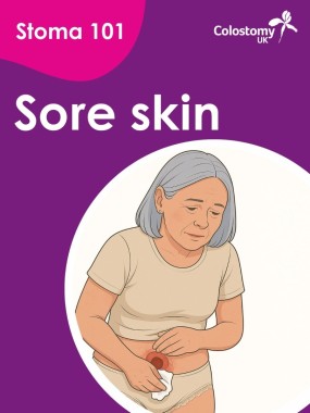 Sore skin and leaks can affect comfort and confidence, but there are simple steps that may help. Changes in stoma size, skin creases, sweating or poor pouch fit can all contribute to problems.  Cleaning the skin with warm water only, making sure the skin is dry before applying your pouch, and checking the fit regularly can help protect your skin and reduce leaks. If problems continue, speak to your stoma care nurse for advice and support.